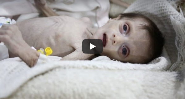 Desnutrición de niños en Siria