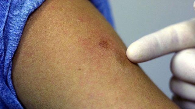 Viruela / Vacuna